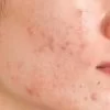 how to remove pimple marks