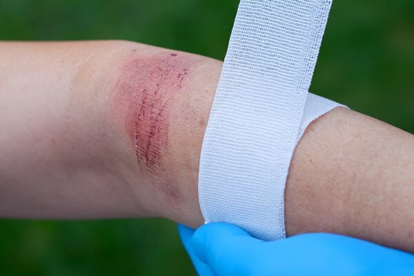 employer for a chemical burn